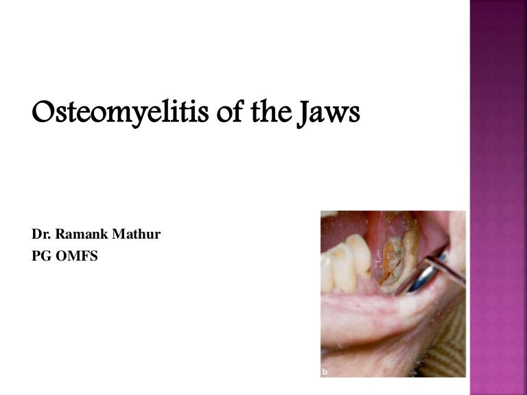 Osteomyelitis of facial bone Playboy pics hustler